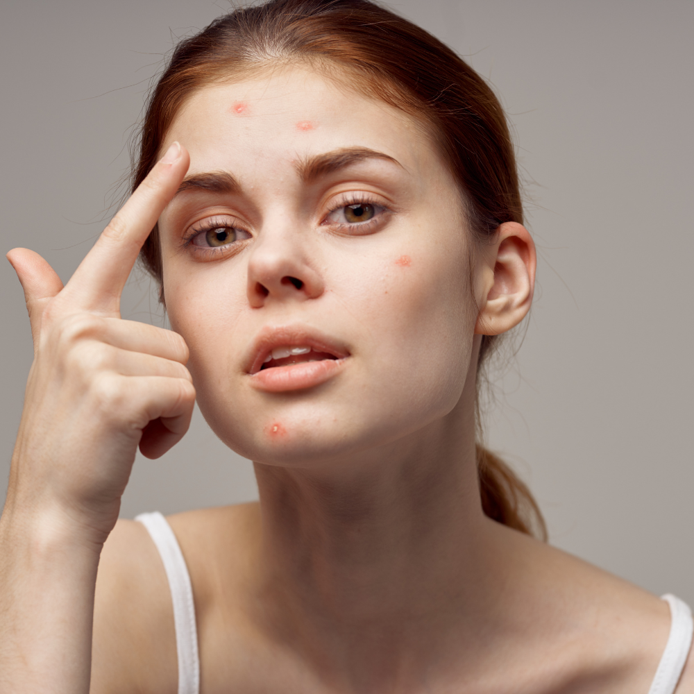 How to Get Rid of Forehead Acne: Your Ultimate Guide